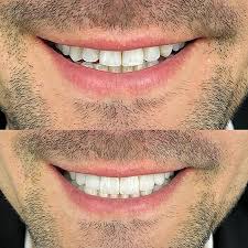 Radiant Smile with OnSmile